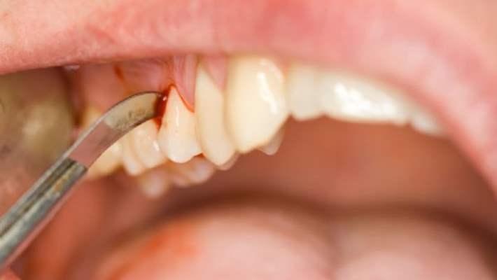 Diş Eti Hastalığının Aşamaları Nelerdir?