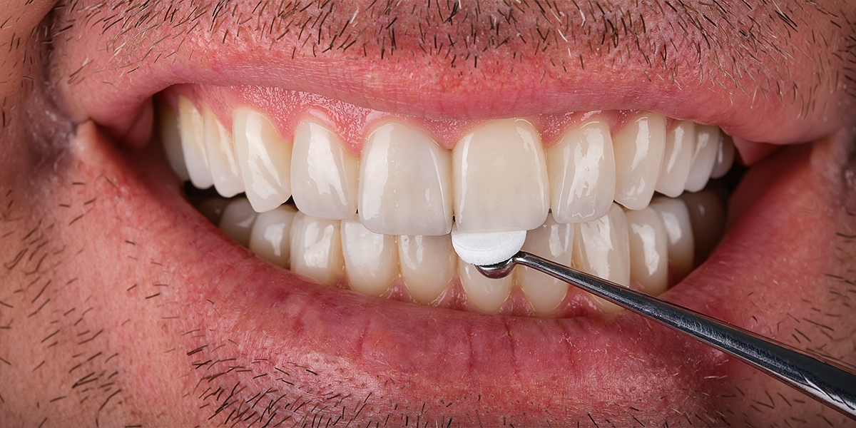 Zirkonyum Diş Nedir? Ne Kadar Dayanır, Doğal Görünür mü?